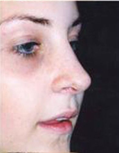 Rhinoplasty Before & After