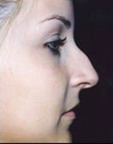 Rhinoplasty Before & After