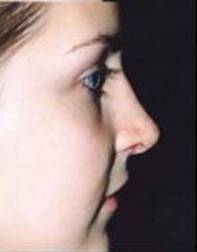 Rhinoplasty Before & After