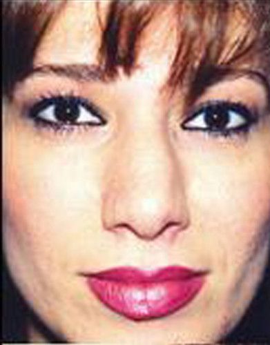 Rhinoplasty Before & After