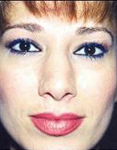 Rhinoplasty Before & After