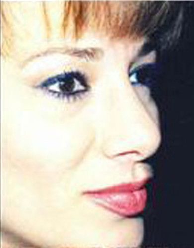 Rhinoplasty Before & After