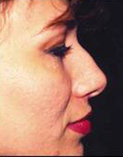 Rhinoplasty Before & After