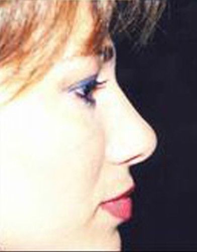 Rhinoplasty Before & After