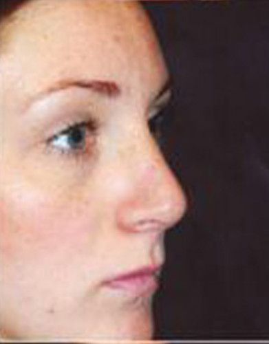 Rhinoplasty Before & After