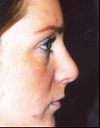 Rhinoplasty Before & After