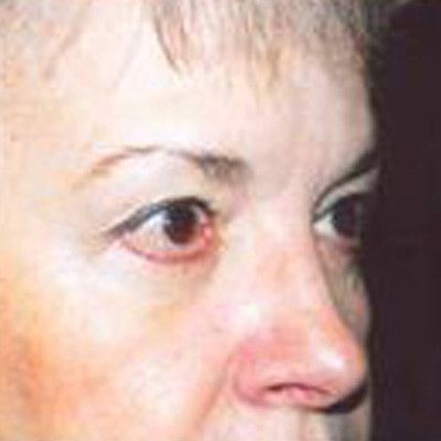 Rhinoplasty Before & After