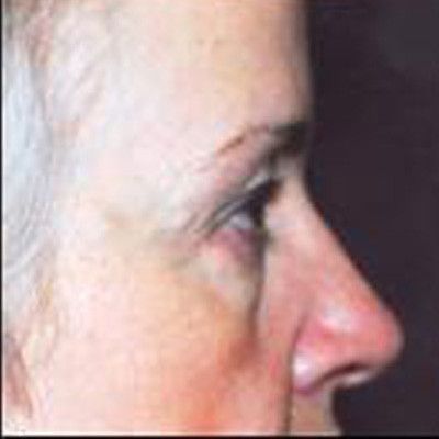 Rhinoplasty Before & After