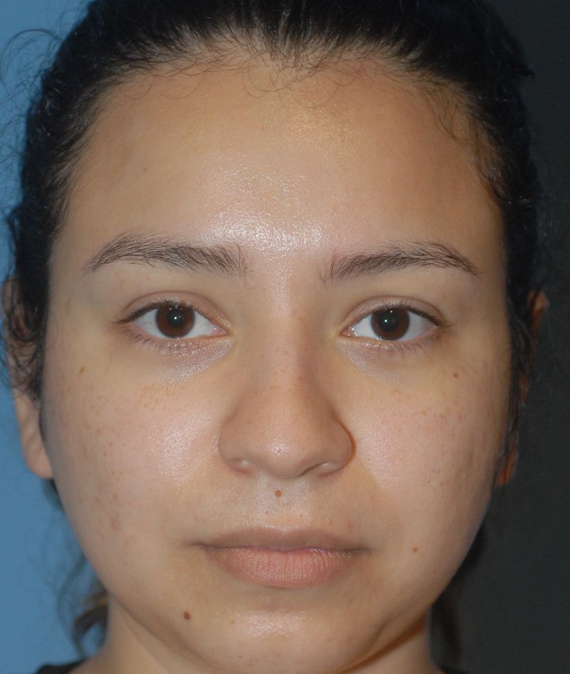 Rhinoplasty Before & After