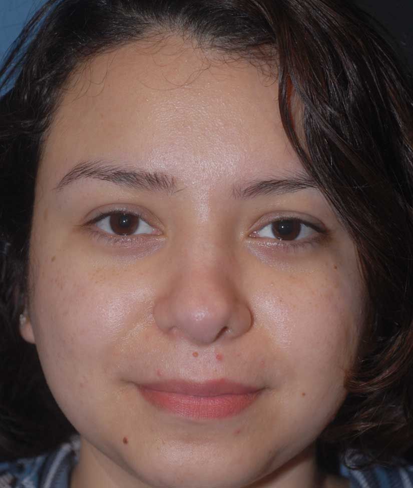 Rhinoplasty Before & After