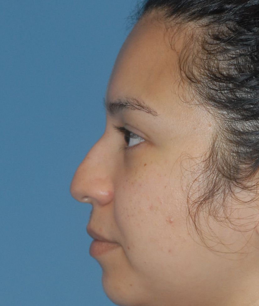 Rhinoplasty Before & After