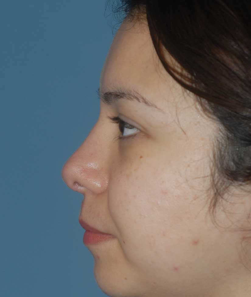 Rhinoplasty Before & After