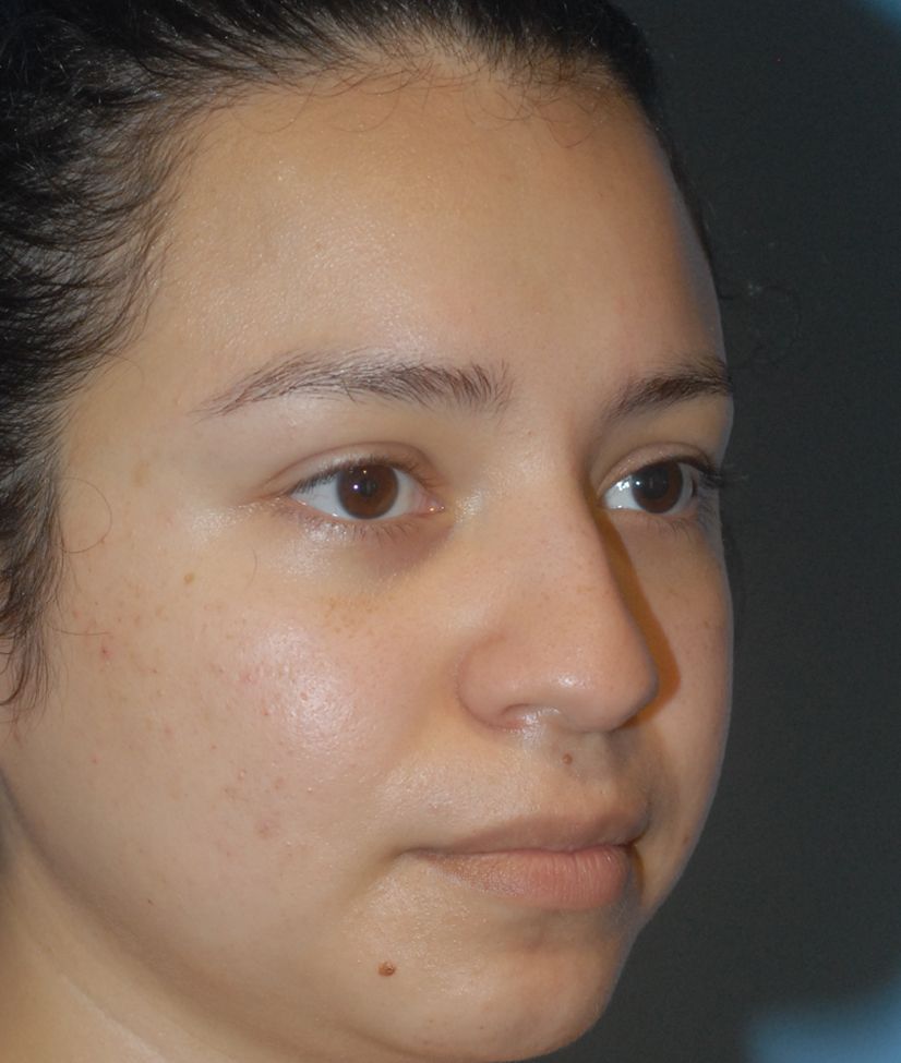 Rhinoplasty Before & After