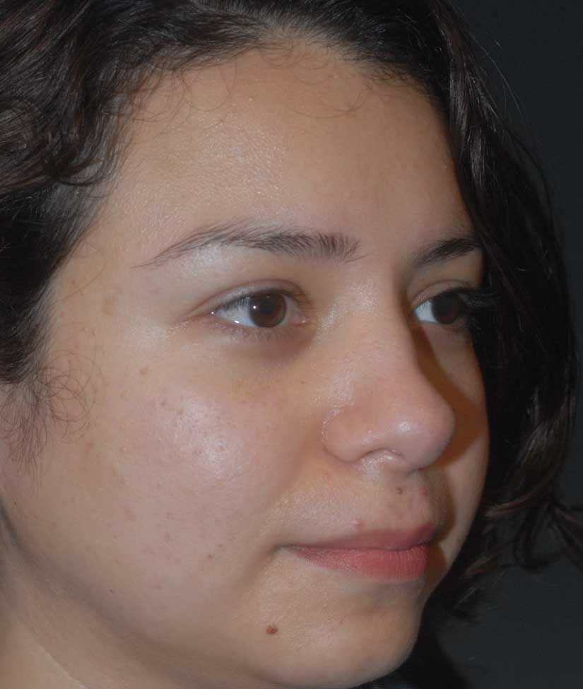 Rhinoplasty Before & After