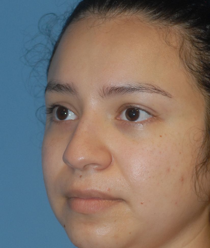 Rhinoplasty Before & After