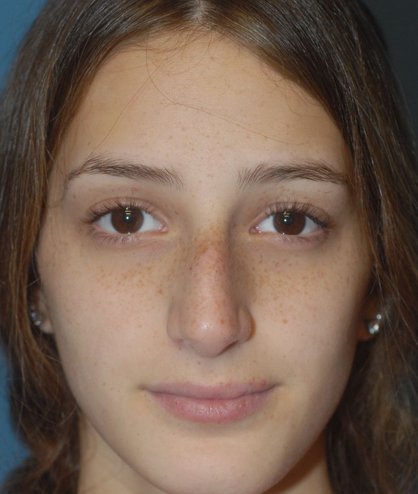 Rhinoplasty Before & After