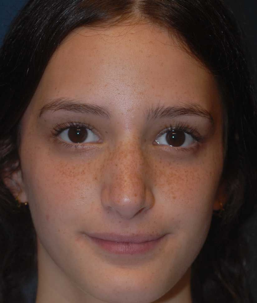 Rhinoplasty Before & After