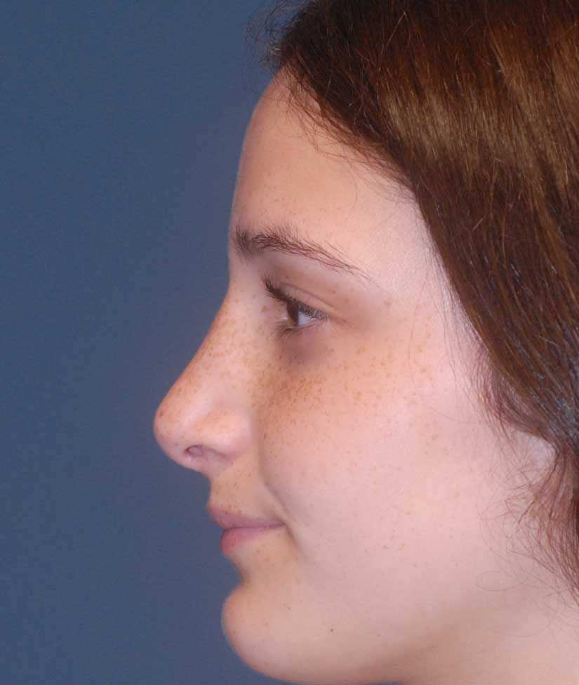 Rhinoplasty Before & After