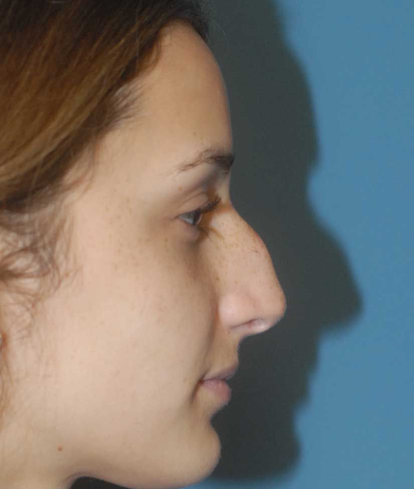 Rhinoplasty Before & After