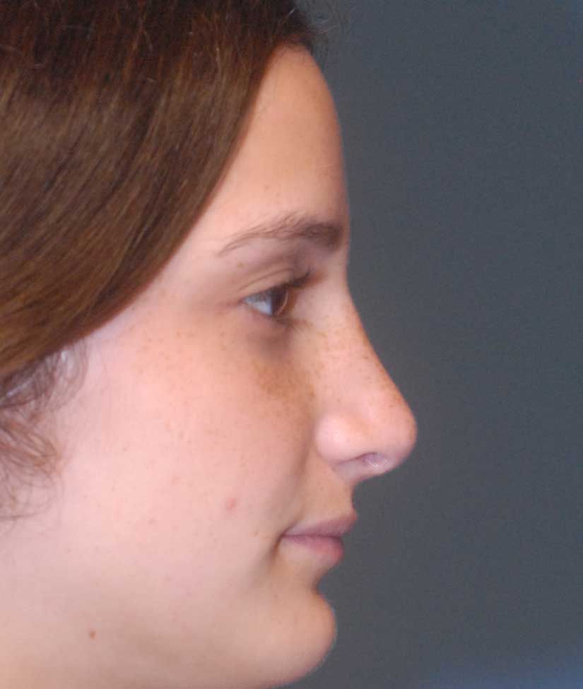 Rhinoplasty Before & After