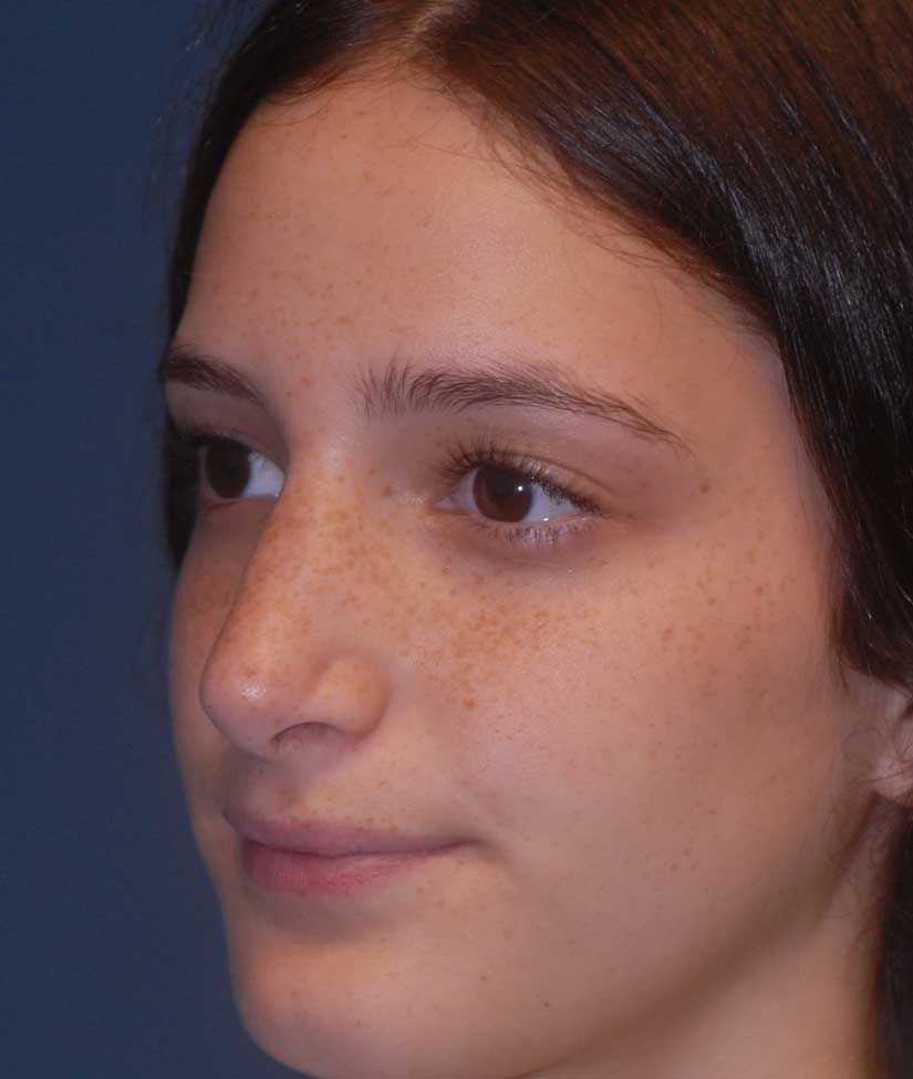 Rhinoplasty Before & After