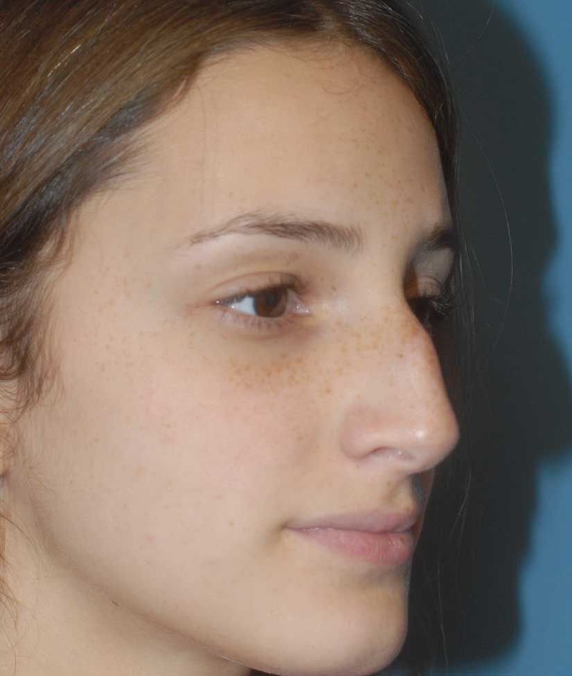 Rhinoplasty Before & After