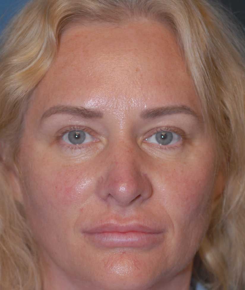 Rhinoplasty Before & After