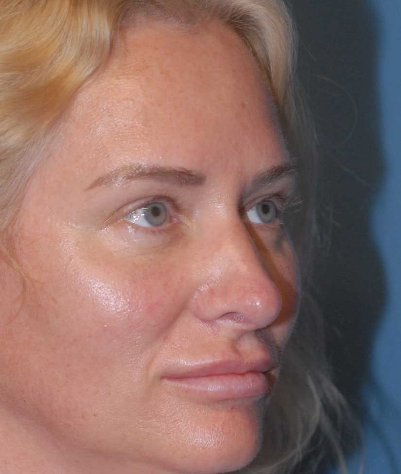 Rhinoplasty Before & After