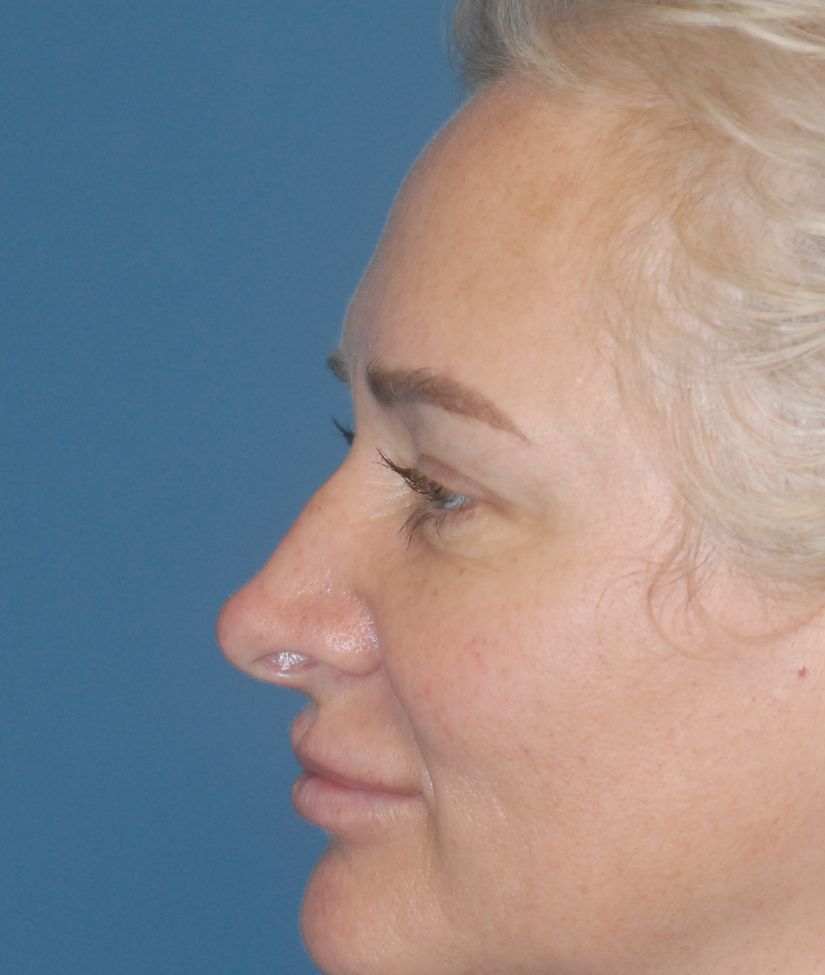Rhinoplasty Before & After