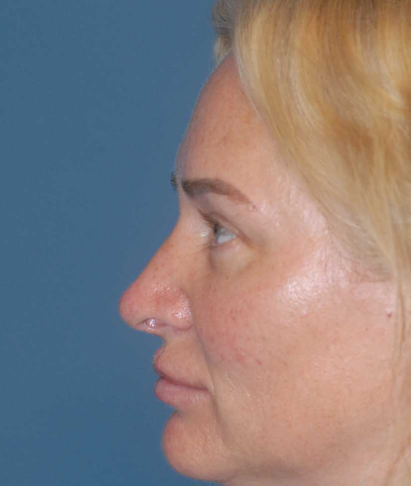 Rhinoplasty Before & After