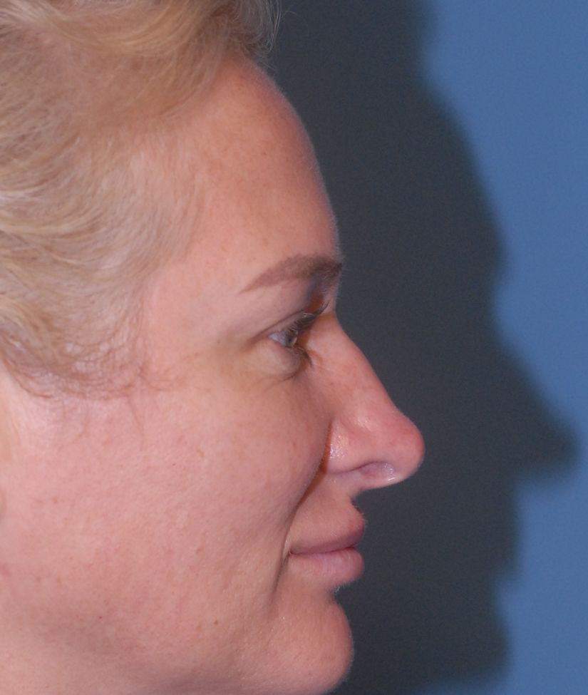 Rhinoplasty Before & After
