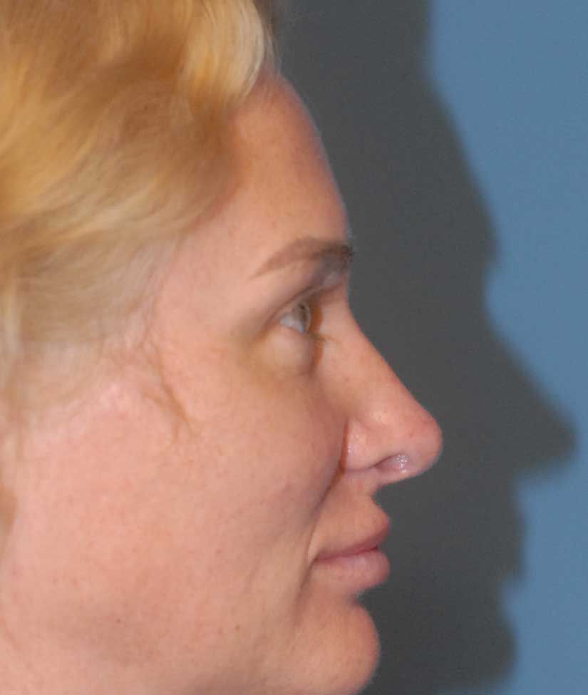 Rhinoplasty Before & After