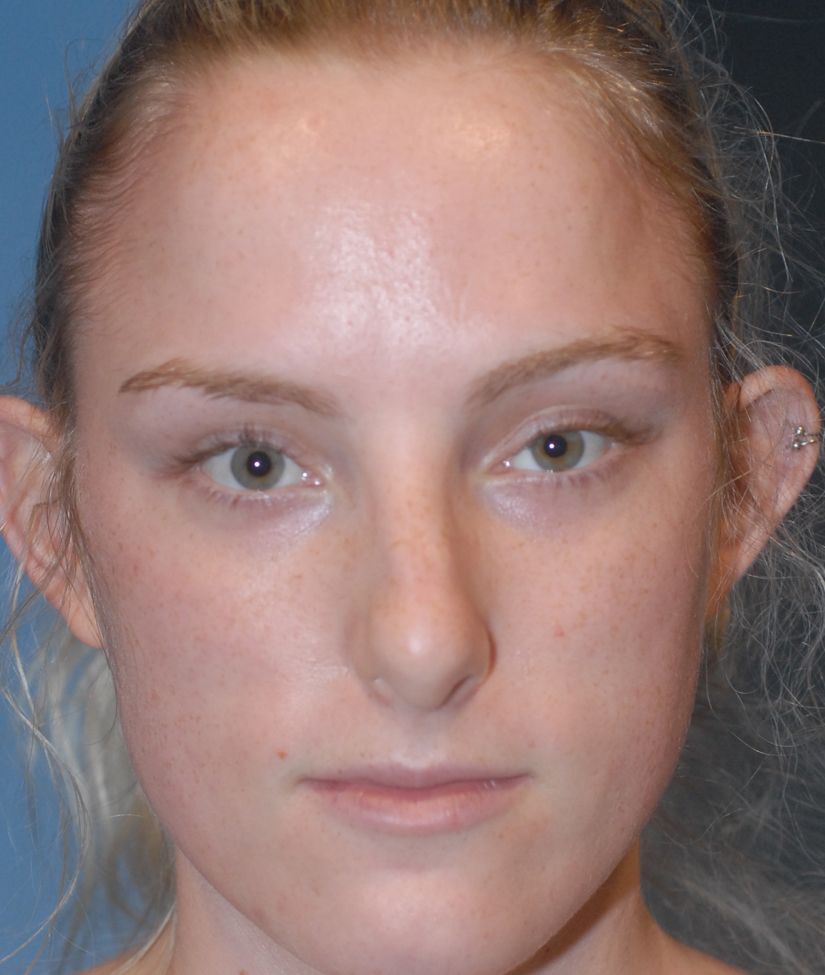 Rhinoplasty Before & After