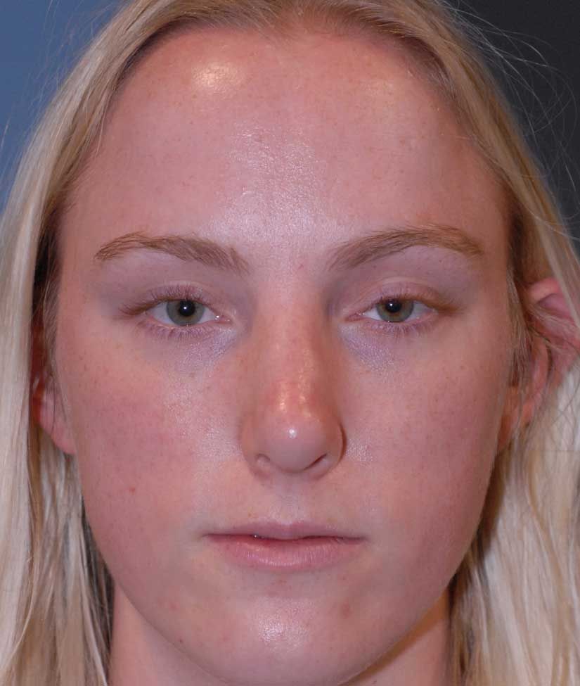 Rhinoplasty Before & After