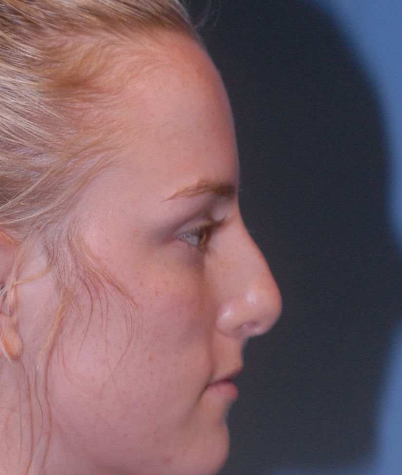 Rhinoplasty Before & After