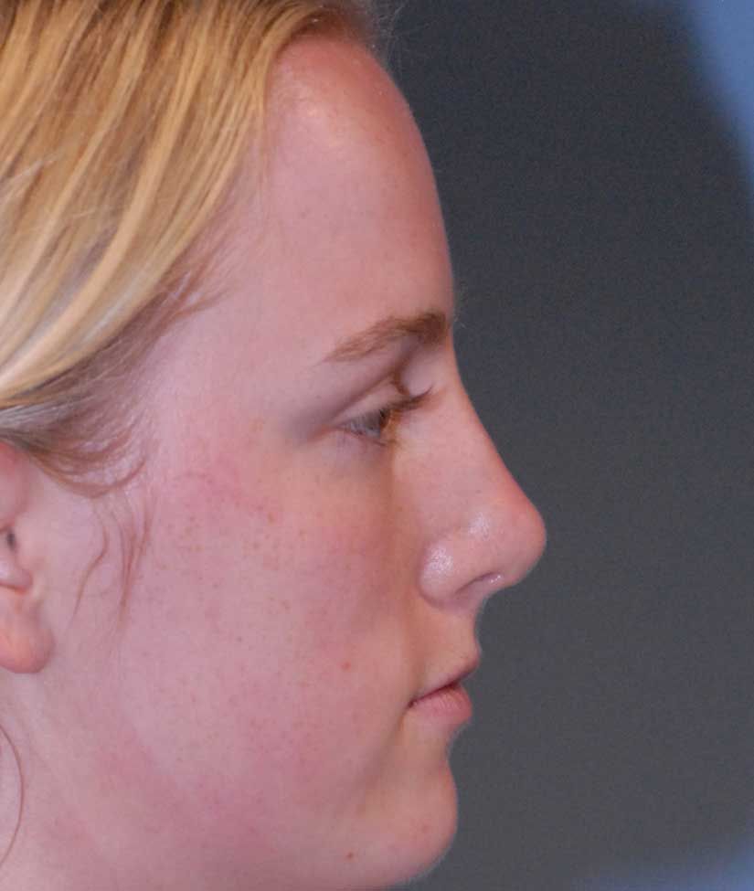 Rhinoplasty Before & After