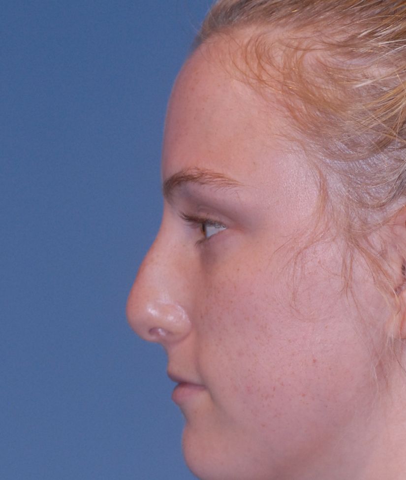 Rhinoplasty Before & After