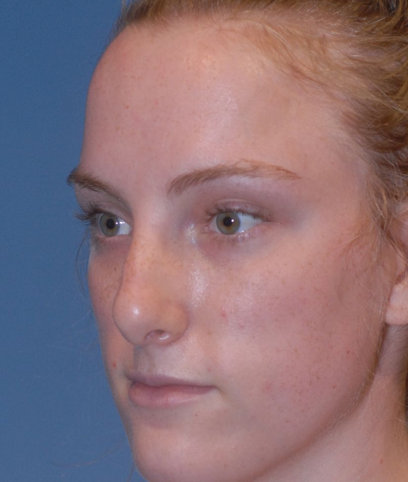 Rhinoplasty Before & After