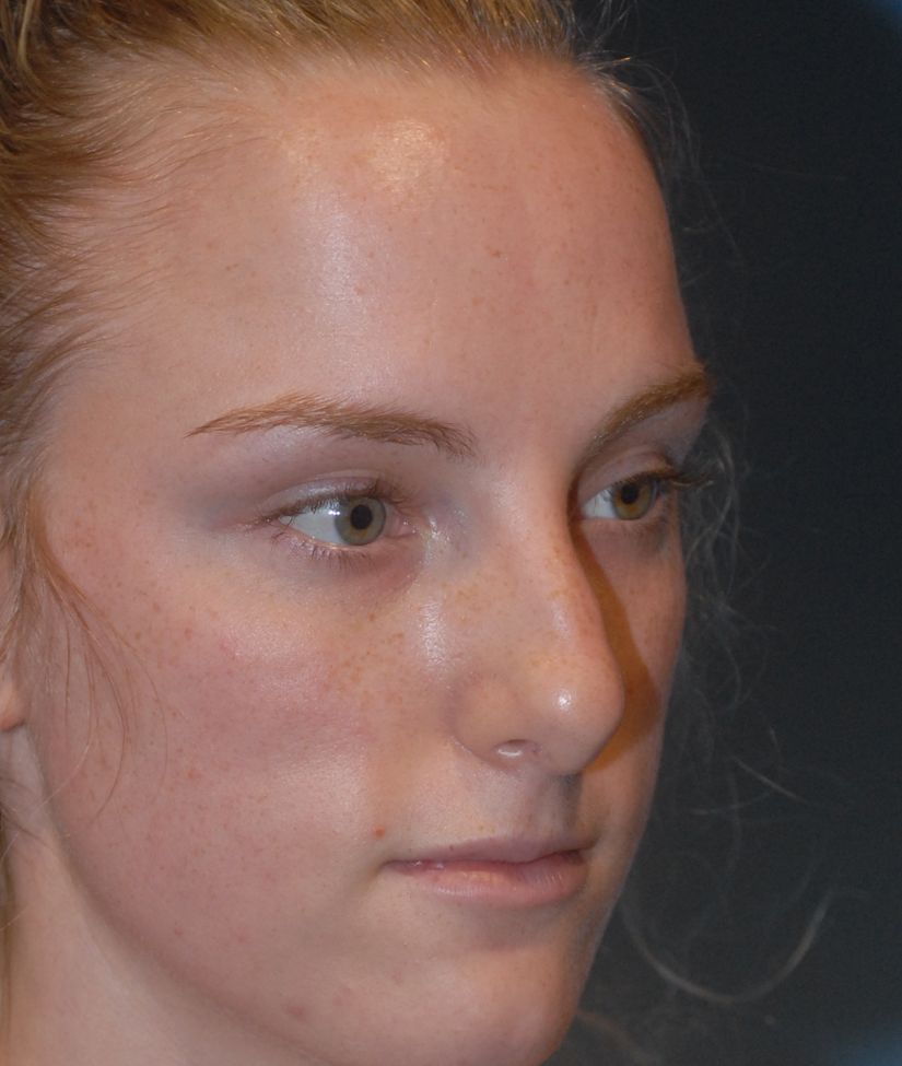 Rhinoplasty Before & After