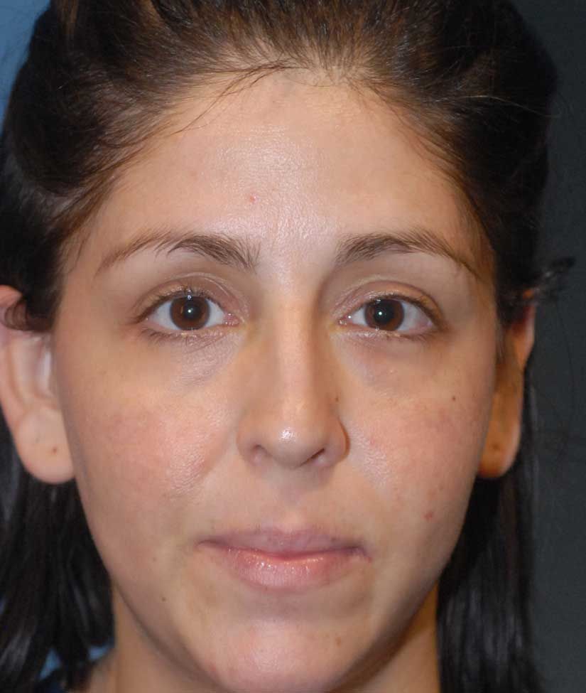 Rhinoplasty Before & After