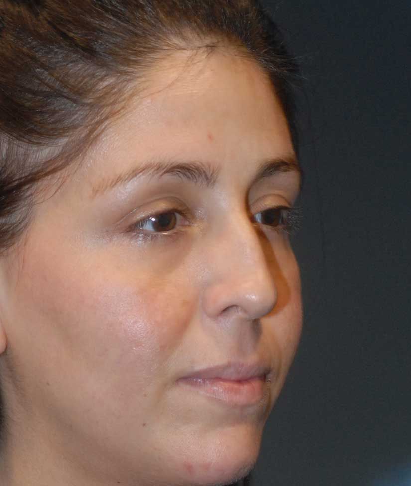 Rhinoplasty Before & After