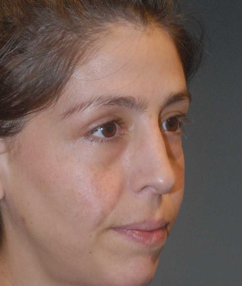 Rhinoplasty Before & After