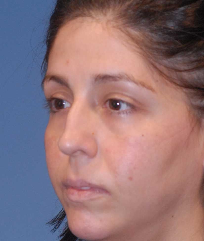 Rhinoplasty Before & After