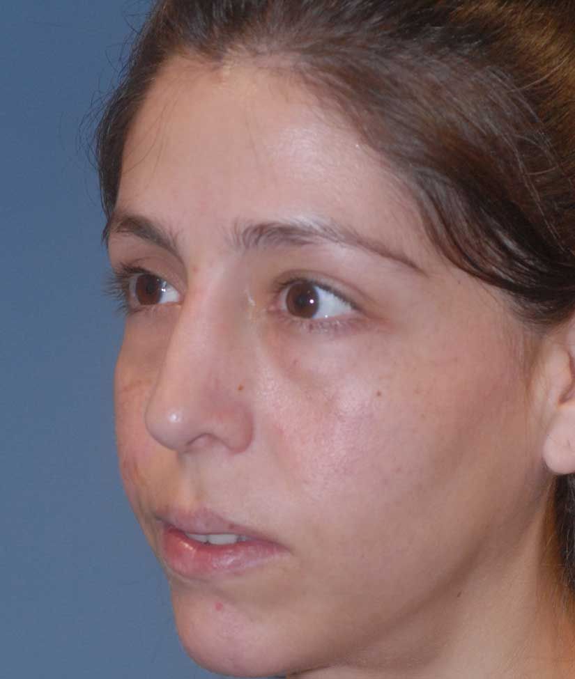 Rhinoplasty Before & After