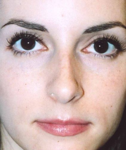 Rhinoplasty Before & After