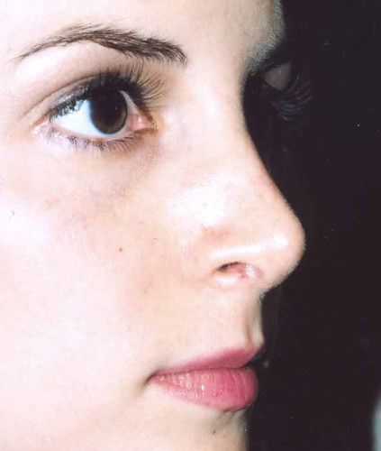 Rhinoplasty Before & After