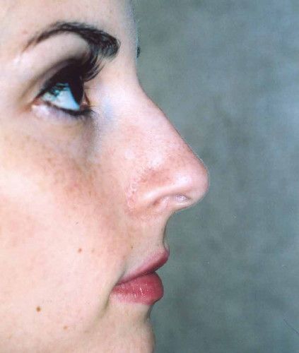 Rhinoplasty Before & After