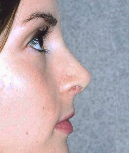 Rhinoplasty Before & After