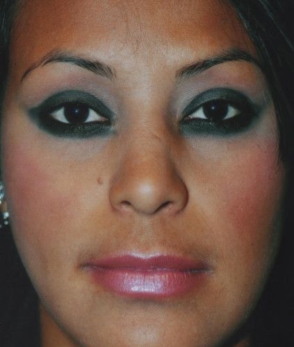 Rhinoplasty Before & After