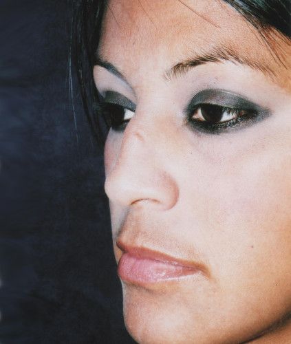 Rhinoplasty Before & After